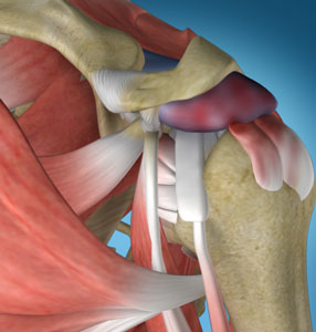 Shoulder Impingement and Bursitis