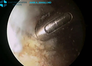 Arthroscopic Treatment of Avascular Necrosis of the Hip