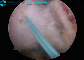 Clinical Case Presentation: Arthroscopic Rotator Cuff Repair
