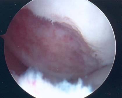 fresh-osteochondral-allografting