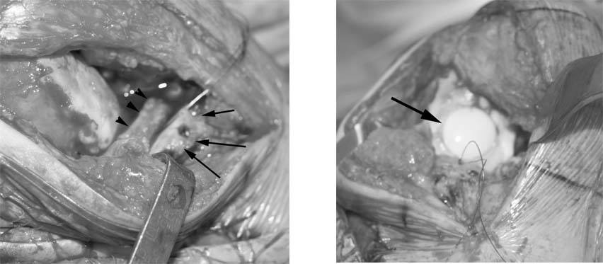 fresh-osteochondral-allografting