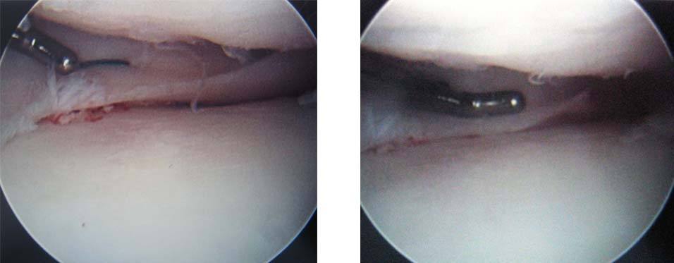 fresh-osteochondral-allografting