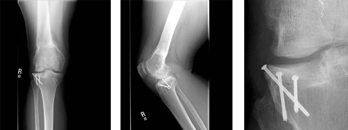 fresh-osteochondral-allografting