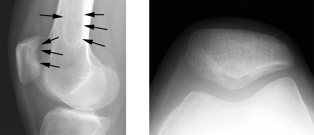 fresh-osteochondral-allografting