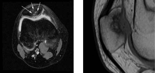 fresh-osteochondral-allografting
