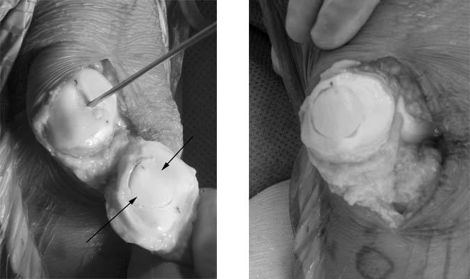 fresh-osteochondral-allografting
