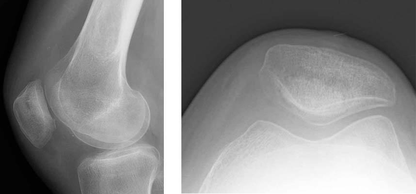fresh-osteochondral-allografting