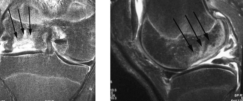 fresh-osteochondral-allografting