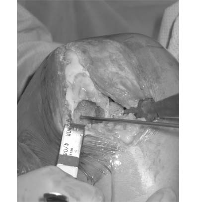 fresh-osteochondral-allografting