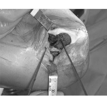 fresh-osteochondral-allografting