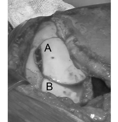 fresh-osteochondral-allografting