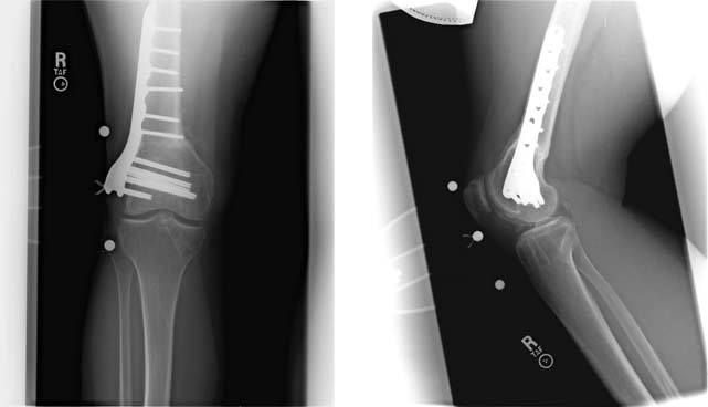 fresh-osteochondral-allografting