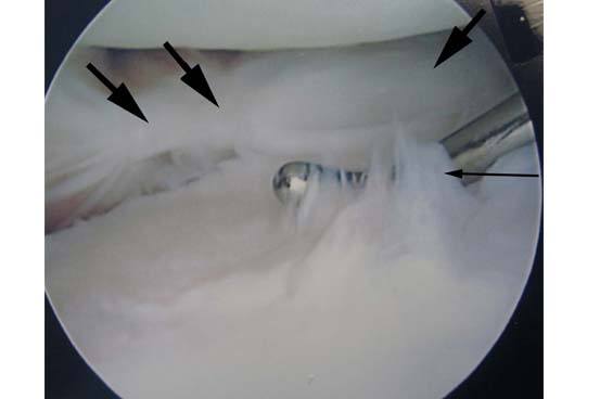 fresh-osteochondral-allografting