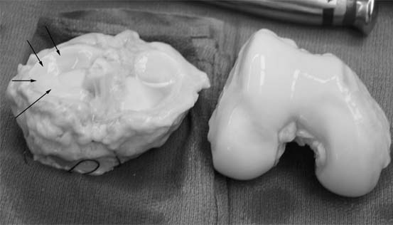fresh-osteochondral-allografting