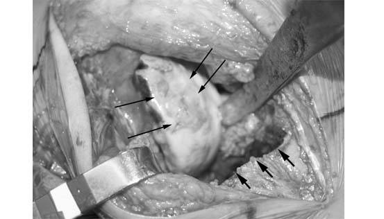 fresh-osteochondral-allografting