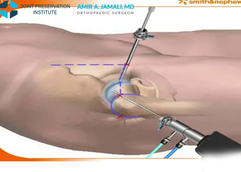 Hip Arthroscopy and FAI Treatment Animation