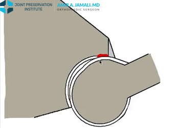 Hip Impingement Animation in 2D