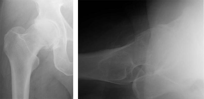 hip-resurfacing-anthroplasty