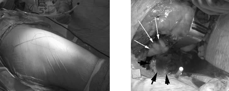 hip-resurfacing-anthroplasty