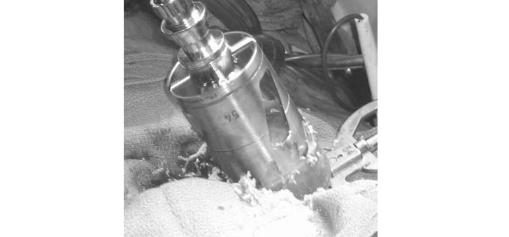 hip-resurfacing-anthroplasty