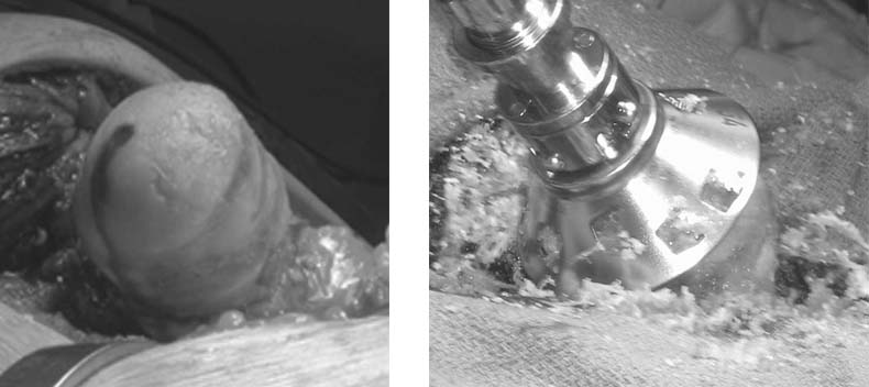 hip-resurfacing-anthroplasty