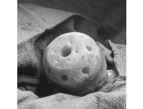 hip-resurfacing-anthroplasty