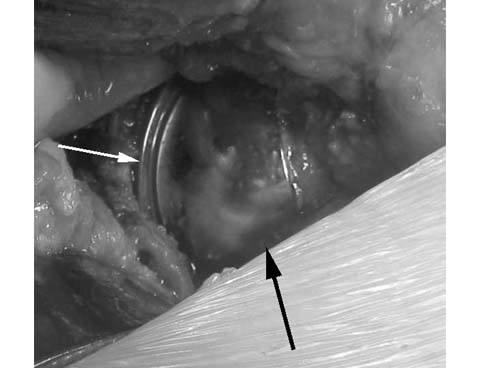 hip-resurfacing-anthroplasty