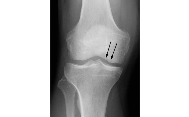 knee-cartilage-repair