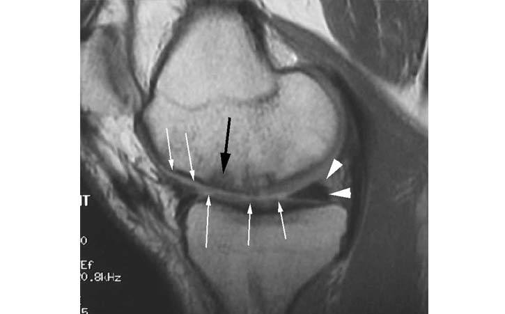 knee-cartilage-repair