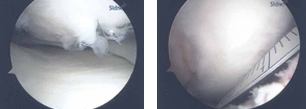 knee-cartilage-repair