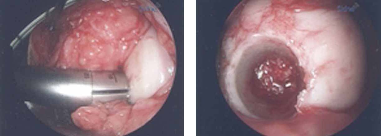 knee-cartilage-repair