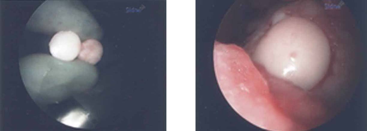 knee-cartilage-repair