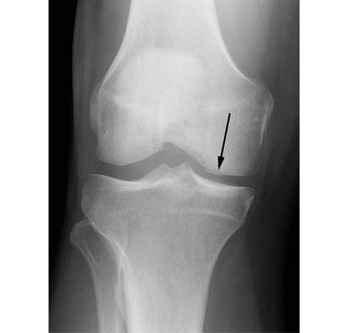 knee-cartilage-repair