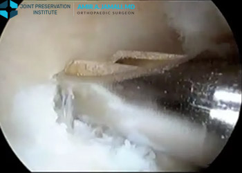 Management of Severe Pincer Type Femoroacetabular Impingement with Hip Arthroscopy