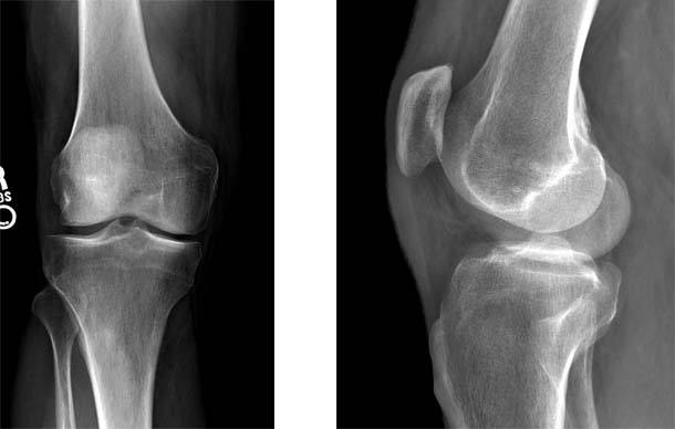 mensical-transplatation