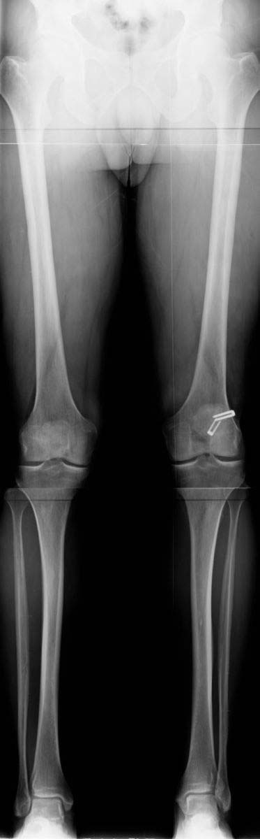 mensical-transplatation