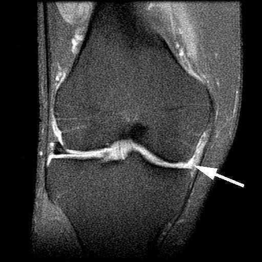 mensical-transplatation