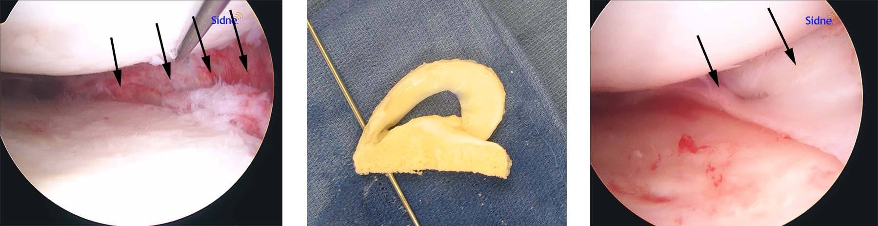 mensical-transplatation