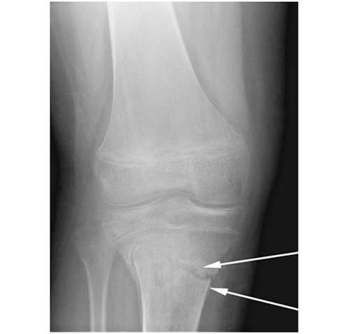 osteotomies-knee