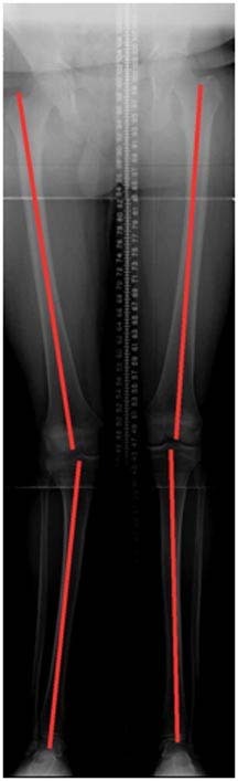 osteotomies-knee