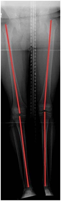 osteotomies-knee