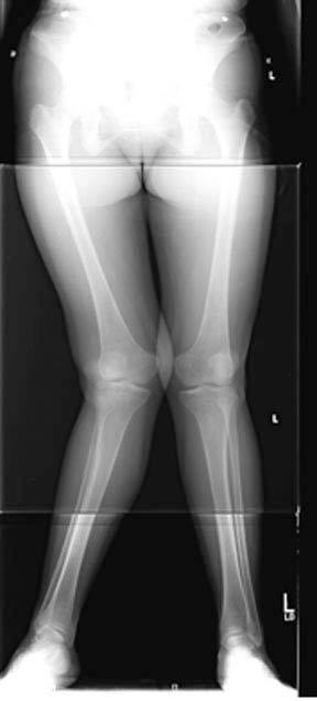 osteotomies-knee