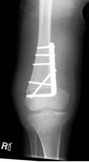 osteotomies-knee