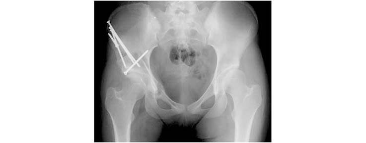 periacetabular-osteotomy