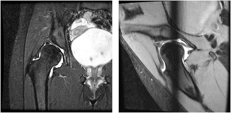 periacetabular-osteotomy