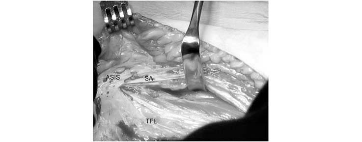 periacetabular-osteotomy
