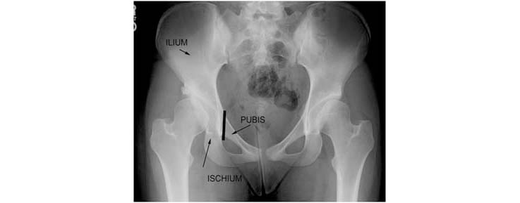 periacetabular-osteotomy
