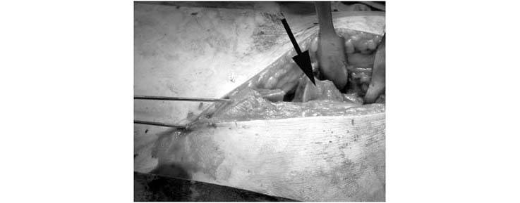 periacetabular-osteotomy