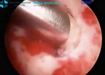 Radiographic Analysis in Femoroacetabular Impingement with Bone Grafting of the Femoral Head