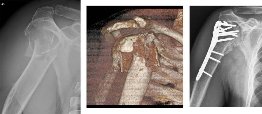 shoulder-arthroscopy